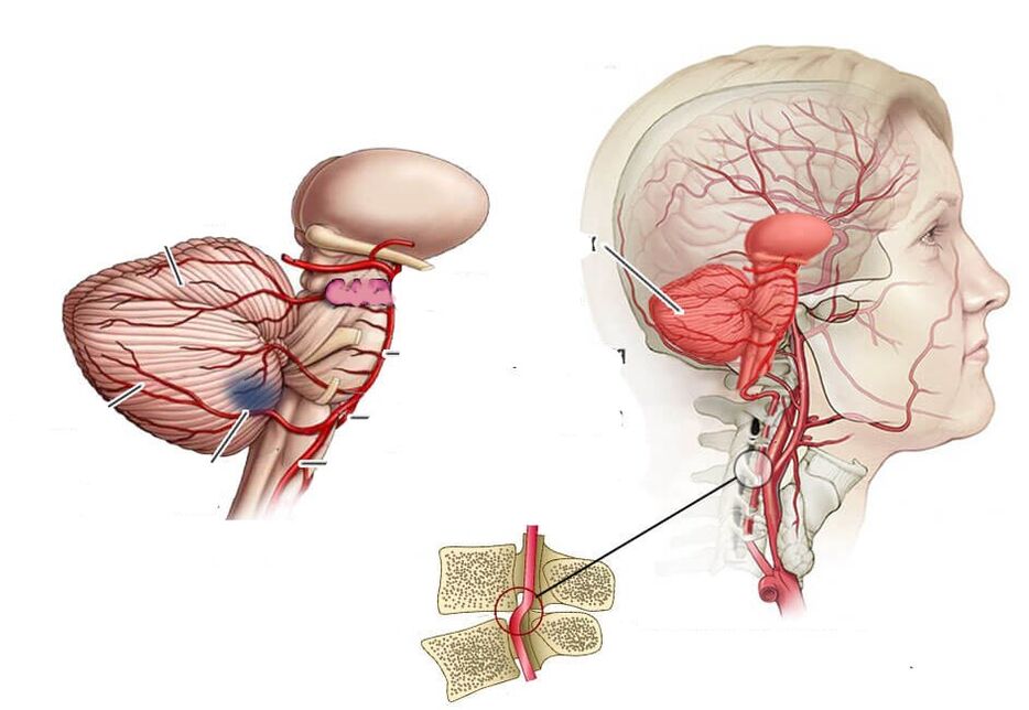 Cerebelárna ischémia